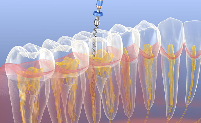 What is Endodontics Treatment or Root Canal Treatment in Dentistry?